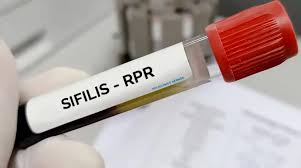 sifilis